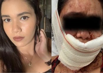 Mulher é atacada com mordidas pelo namorado após rir dele em Fortaleza