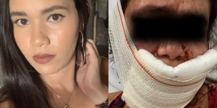 Mulher é atacada com mordidas pelo namorado após rir dele em Fortaleza