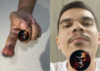 Homem tem crise de ciúmes e ataca namorada decepando dedo com os dentes; Entenda o caso 