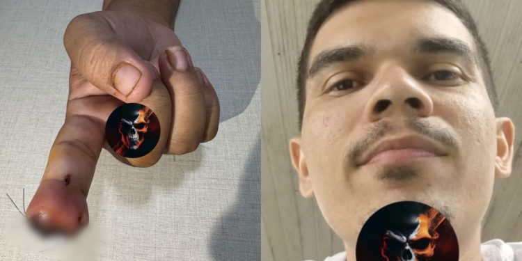 Homem tem crise de ciúmes e ataca namorada decepando dedo com os dentes; Entenda o caso 