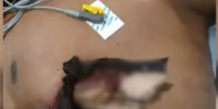 Jovem é ferido por pedaço de madeira durante trabalho em roça no AM