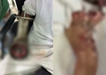 Açougueiro tem mão triturada em acidente com máquina de moer carne; veja o vídeo 