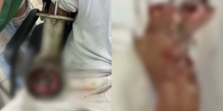 Açougueiro tem mão triturada em acidente com máquina de moer carne; veja o vídeo 