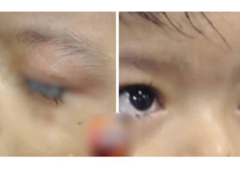 Criança de 2 anos cola os próprios olhos com cola industrial no AM